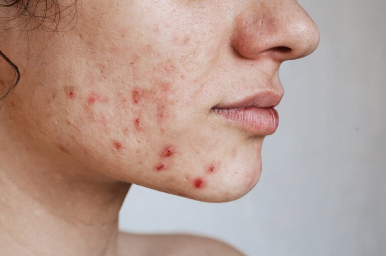 Close-up of the skin of a young girl with problems. Pimples, acne, pores, scars