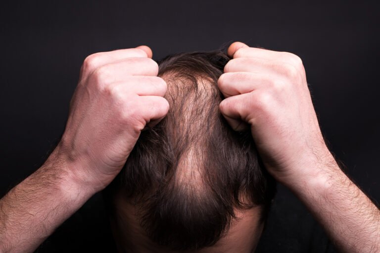 A man grabs his hair. Head with baldness. The problem of hair growth on the head