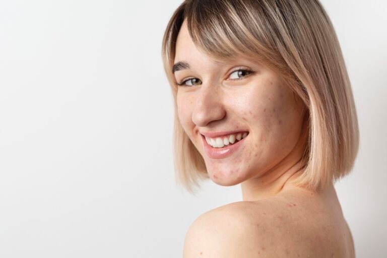 smiley-woman-with-acne-posing