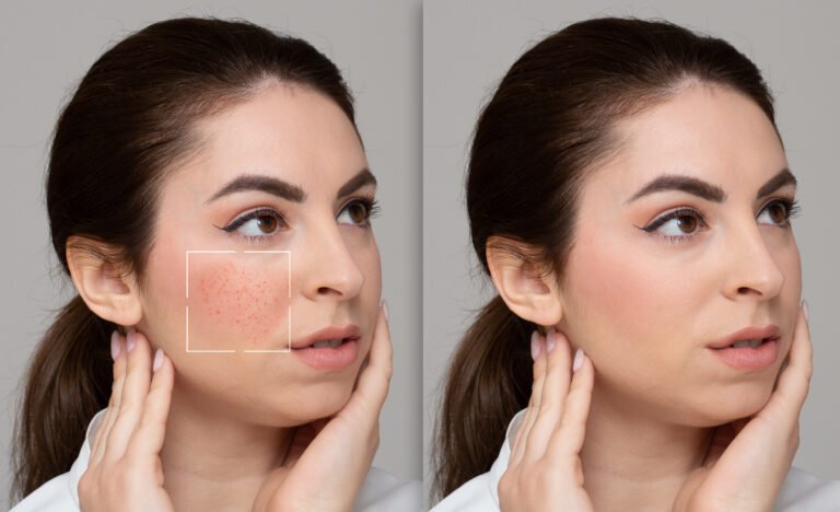 face of girl suffering from rosacea before and after a treats